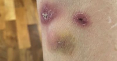 Skin-blistering fungal disease that's spread by cats is found in the UK for first time