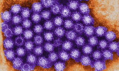 Norovirus cases in over-65s in England at highest in a decade