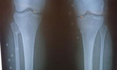 British health worker shot multiple times in Iran protests, injuries show