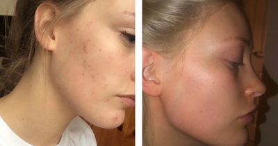 Acne-sufferers ‘can’t go without’ skincare kit that clears spots in a week