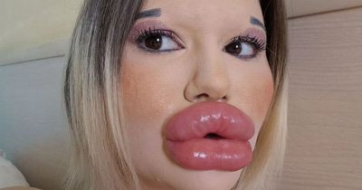 Woman with 'world's biggest lips' wants more filler despite fans fearing 'they'll burst'