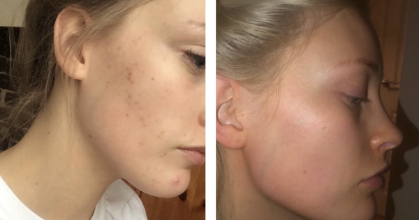 Shoppers rave over 'amazing' face scrub that fades scars and smoothes skin
