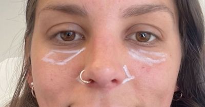 'I got filler to fix my gummy smile - but it made me look like a serial killer'