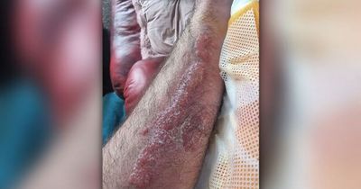 Man's urgent warning after hair dye patch test leaves arms red and blistered in extreme reaction that 'could've put him in coma'