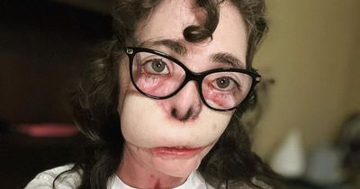 Woman whose face torn off by dogs she was babysitting shares incredible recovery photos