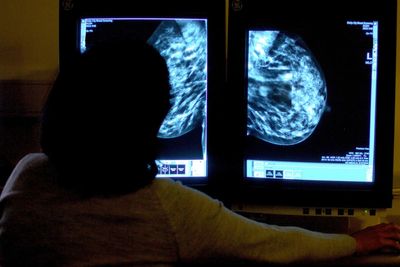 Scientific breakthrough could prevent breast cancer ‘time bomb’