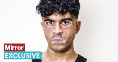 'I don't need a new miracle cream to be 'cured' - I learnt that vitiligo is my superpower'