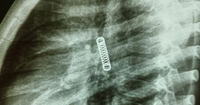 Boy, 5, had metal spring stuck in his lung for THREE MONTHS which caused constant coughing