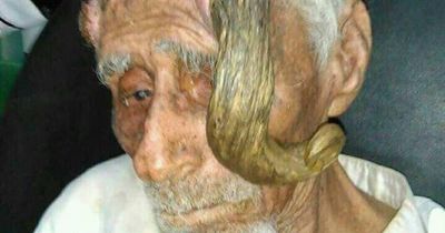 'World's oldest man' dies as devastated family slam 'botched op' to remove horns