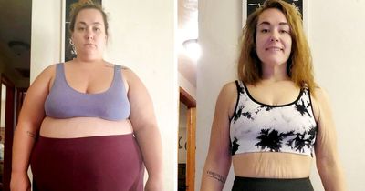 Mum who shed 14 stone left with 'body of a 90-year-old woman' because of 25lb of loose skin