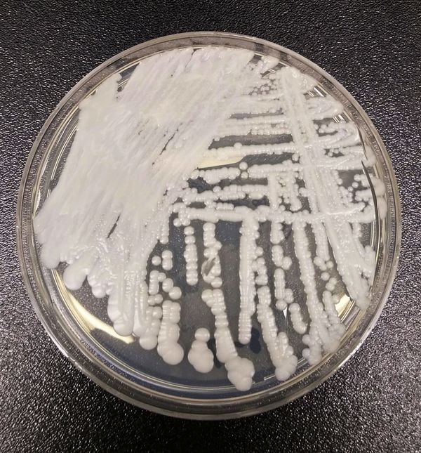 The potentially deadly Candida auris fungus is spreading quickly in the U.S.