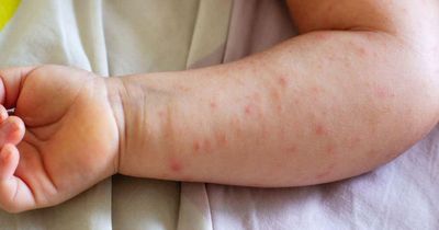 NHS told to stop prescribing one type of eczema treatment