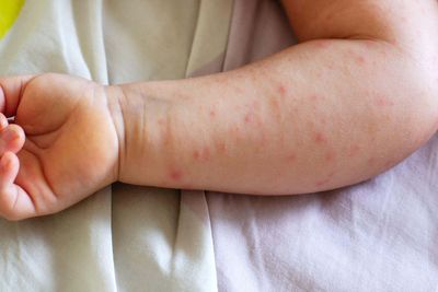 Children with eczema ‘should not be offered bath emollients on the NHS’