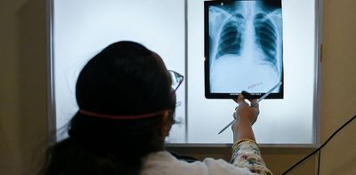 TB kills 75,000 children in Africa every year: how this can stop