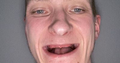 Man hoping to get new smile and find love after illness made him lose his teeth