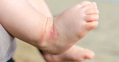 NHS told to stop prescribing certain type of eczema treatment to children