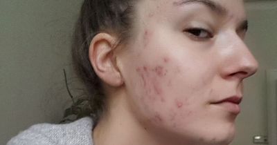 Woman with 'terrible' acne finally finds solution to her skin problems