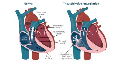 Forgotten heart valve: New treatment for nasty killer