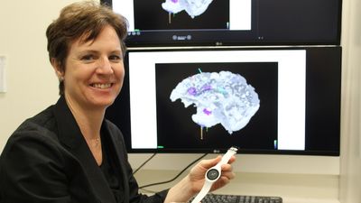 Queensland researchers to study brain activity of patients with epilepsy — hope to detect seizures with smart watches