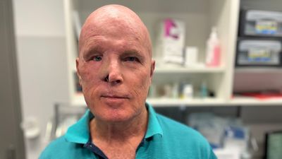 Wayne was 'very close' to losing his eye to skin cancer. His doctor urges sun safety to be taken seriously