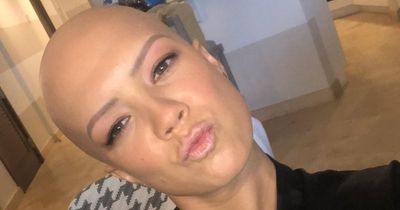 Model with alopecia says she is thankful she lost her hair
