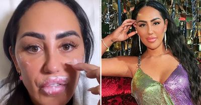 Sophie Kasaei shows off quick transformation after getting filler injected under her eyes