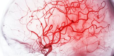 Brains also have supply chain issues – blood flows where it can, and neurons must make do with what they get