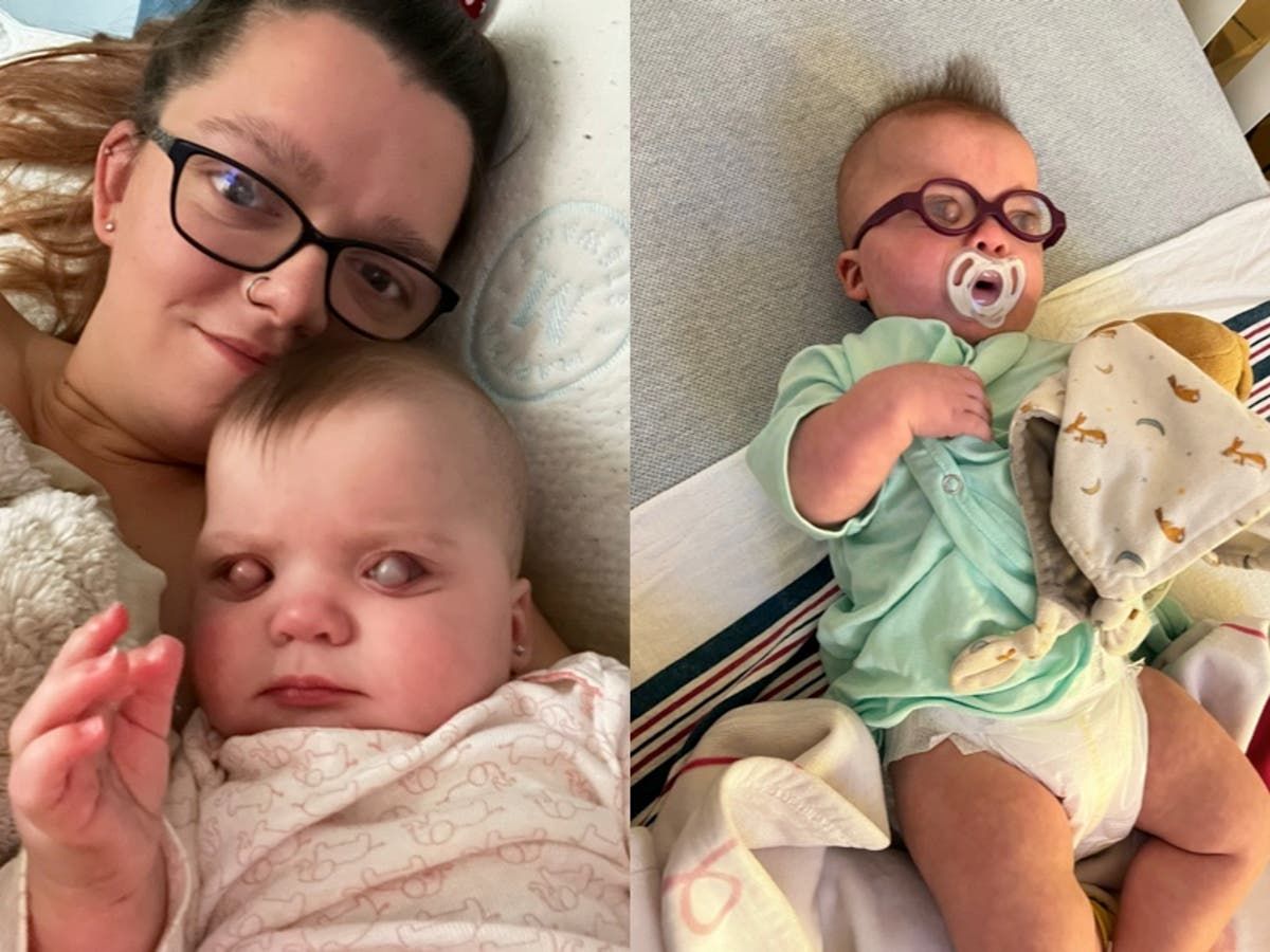 mother-documents-story-of-baby-born-with-bubble-on