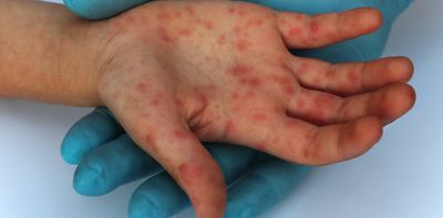 Measles has been identified in NSW, Qld and SA. 5 things to know about the virus