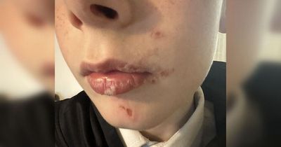 Boy, 11, suffers horror 'chemical burns' after being beaten unconscious in park
