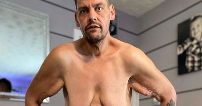 Man who lost half his body weight needs £35k to have three stone of skin removed