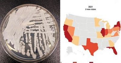 Candida auris fungus: 'Global health threat' spreads to HALF of US - see state-by-state