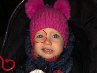‘I spotted something in my little girl’s eye while she played — it turned out to be the first sign of cancer’