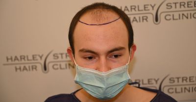 Depressed student bullied for hair loss feels he can 'do anything' after £10k transplant