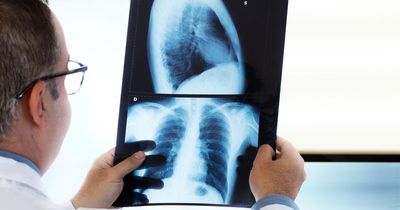 New lung cancer tool can identify those most as risk of developing disease