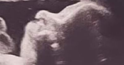 Mum-to-be left cracking up after spotting 'Cookie Monster' in her pregnancy scan