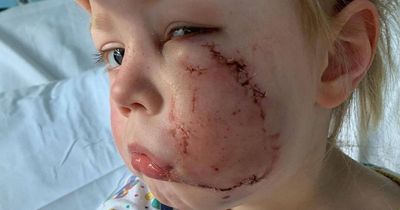 Girl, 4, mauled by American Bulldog needed 40 stitches and plastic surgery