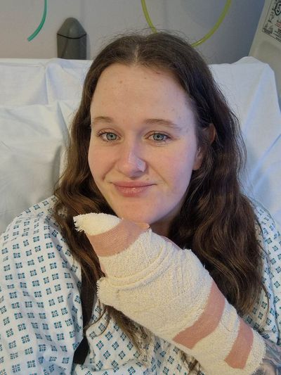 Woman forced to have surgery after ‘spot’ turned out to be false widow spider bite
