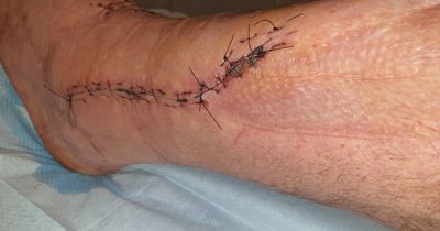 Man shares pictures of his injuries after being run over by forklift at work
