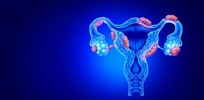 Endometriosis: how the condition may be linked to the immune system