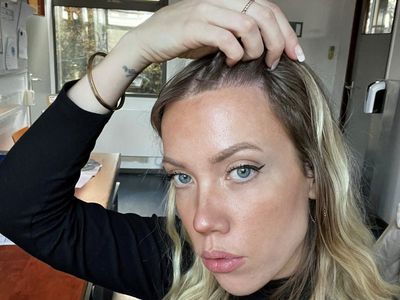 Woman who had hair transplant to cover ‘big forehead’ reveals results