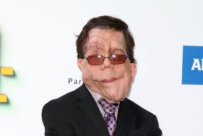 Rise in hate crime against people with disfigurements, research shows