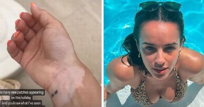 Former Corrie star opens up about having incurable skin condition as she shares holiday snaps