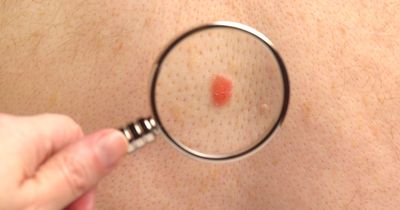 The lesser-known areas where skin cancer develops - including inside the ear