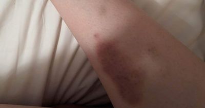 Woman claims DPD delivery driver left her with huge bruises after 'hitting her with trolley'