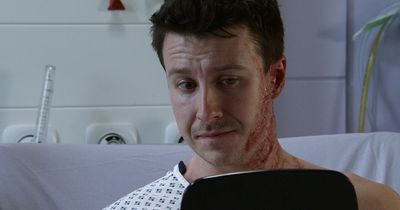 Coronation Street acid attack scars revealed for first time as Ryan Connor unbandaged