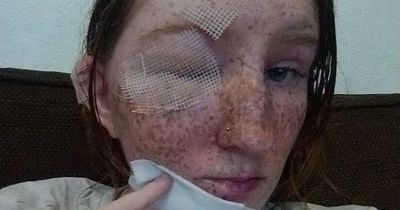 Woman attacked with boiling water so hot her freckles melted in row over pet rat
