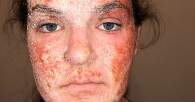 Eczema-sufferer left bed-ridden after extreme reaction to cream caused her skin to peel off