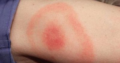 'Stay safe' warning as rare disease is spreading in UK - lyme disease symptoms to look for