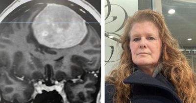Woman who thought seizures were from pandemic stress had tennis ball-sized brain tumour